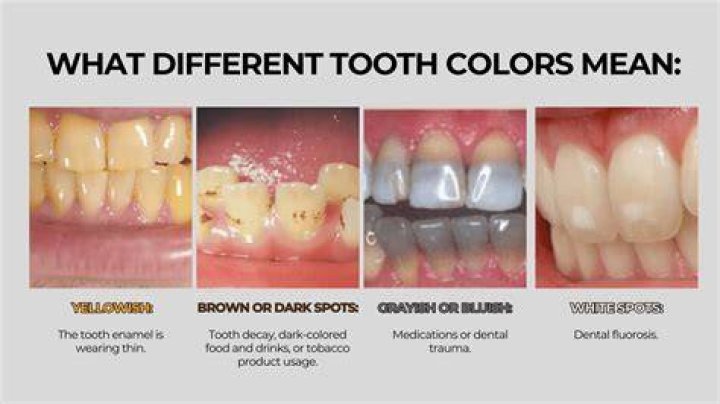 What medicines discolor teeth?