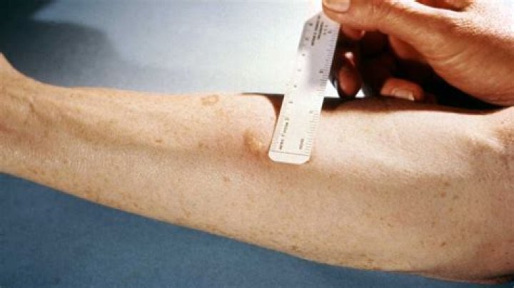What size is a positive TB skin test?