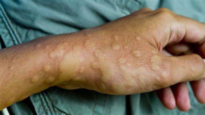 What triggers hives in adults?