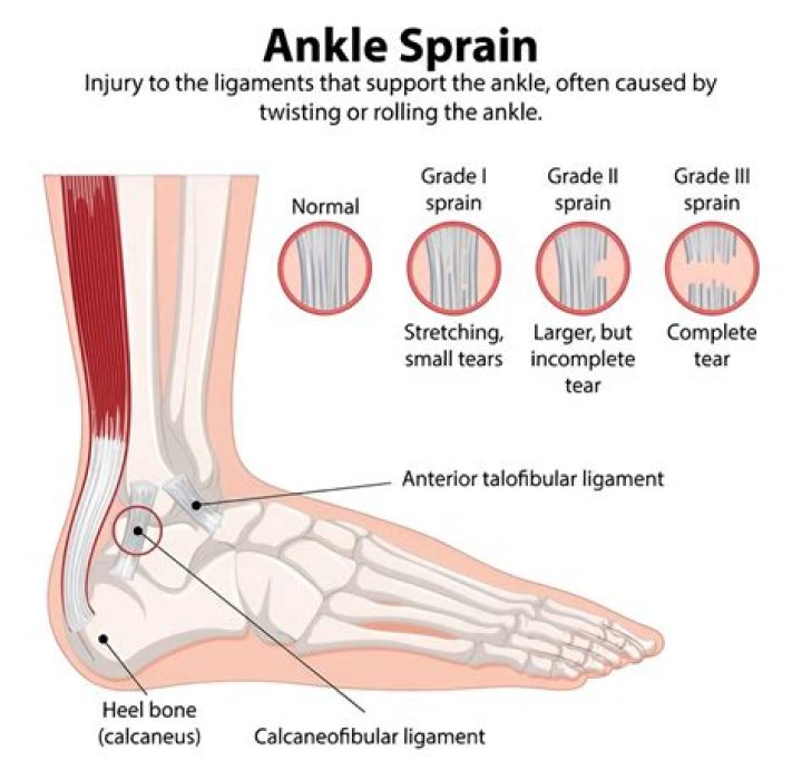 What will happen if an ankle sprain is not treated?