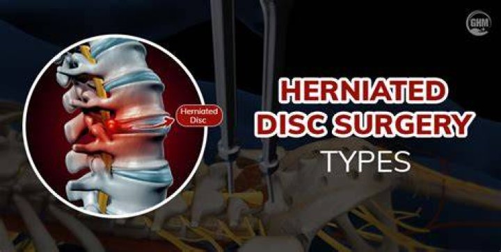 When should you have disc surgery?