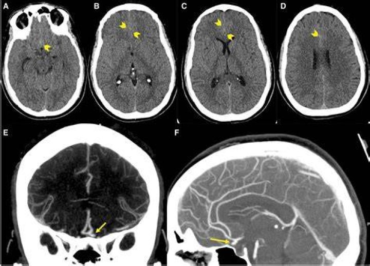 Where is a stroke headache located?