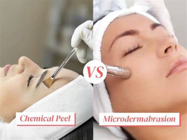 Which is better chemical peel or microdermabrasion?