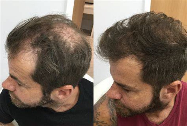 Which oil is best for baldness?