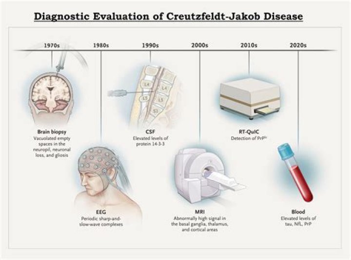 Who is at increased risk of CJD?