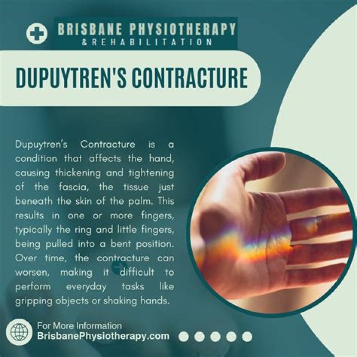Who is prone to Dupuytren's contracture?