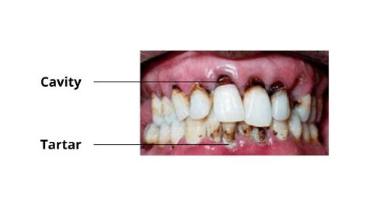 Why are my teeth turning pink?