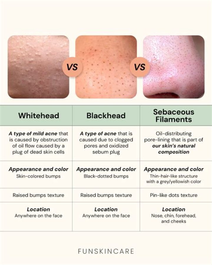 Why do blackheads look like seeds?