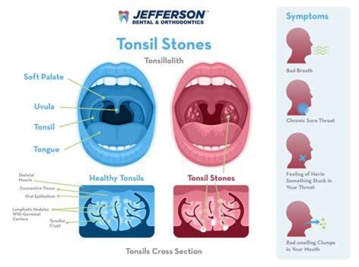 Why do I keep getting tonsil stones?