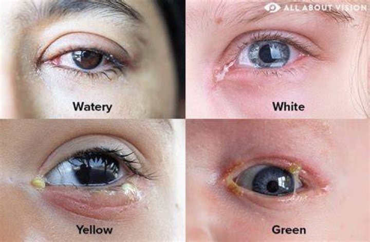 Why do my eyes water when I throw up?
