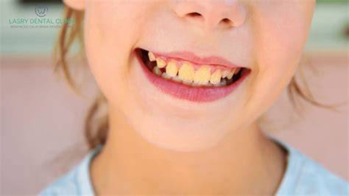 Why do my teeth look worse after braces?