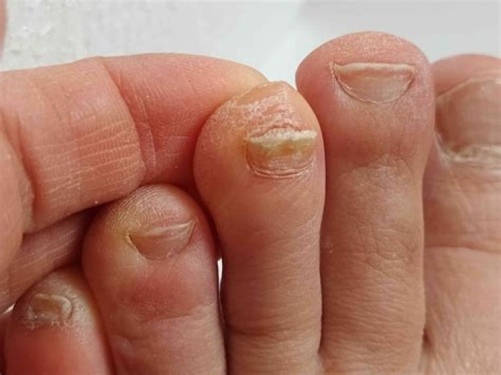 Why do my toenails smell like vomit?