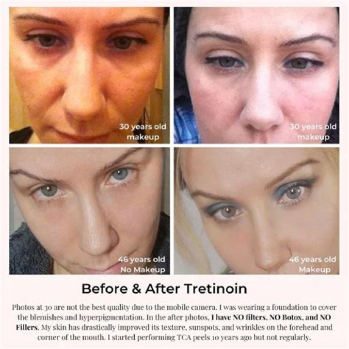Why is tretinoin not working for my acne?