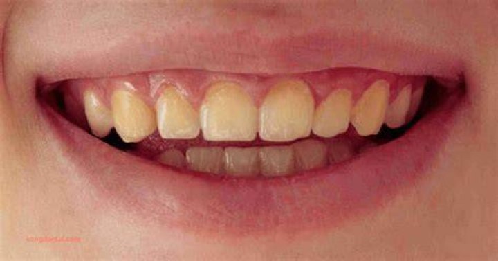 Why my teeth are yellow?