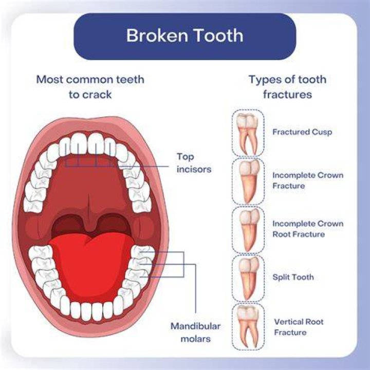 Why would a broken tooth not hurt?