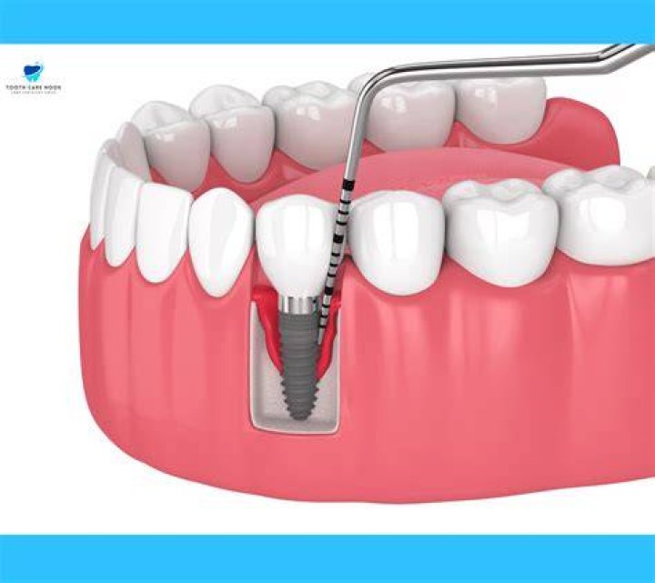 Why would a dental implant need to be removed?