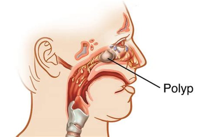Why would a polyp not be removed?