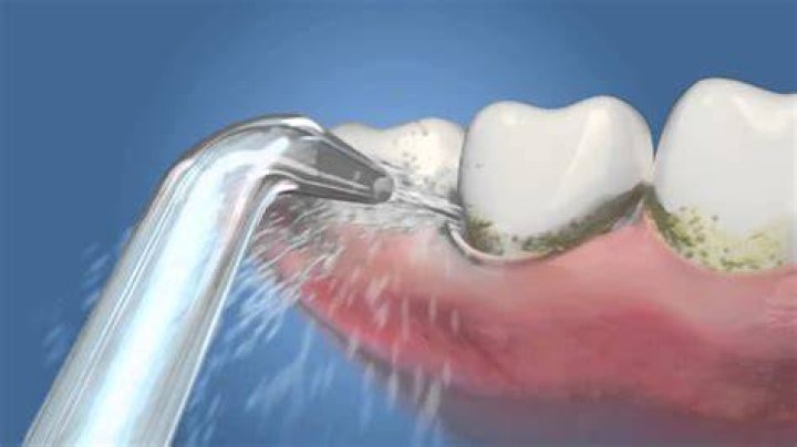 Will a Waterpik help with periodontal disease?