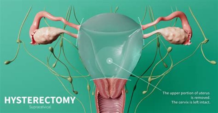 Will I feel better after hysterectomy for fibroids?