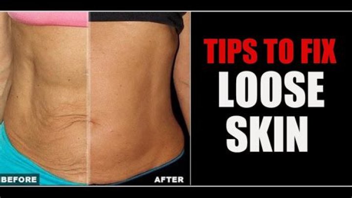 Will loose stomach skin tighten up?