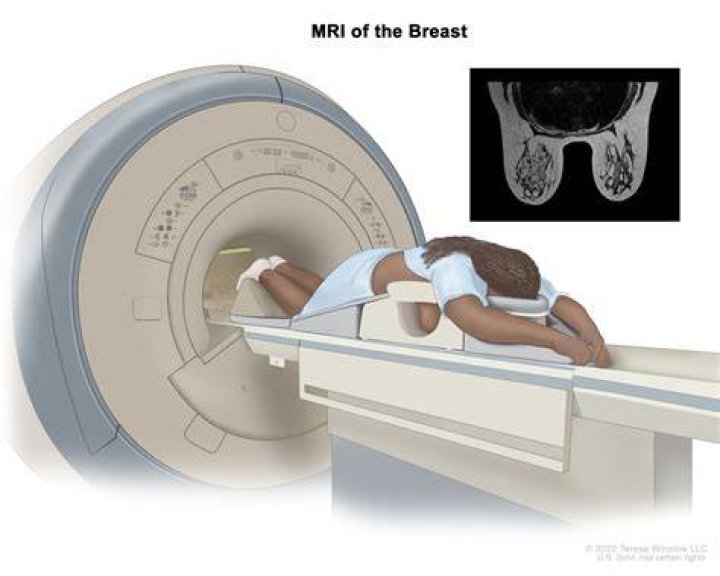 Will Parkinsons show up on an MRI?