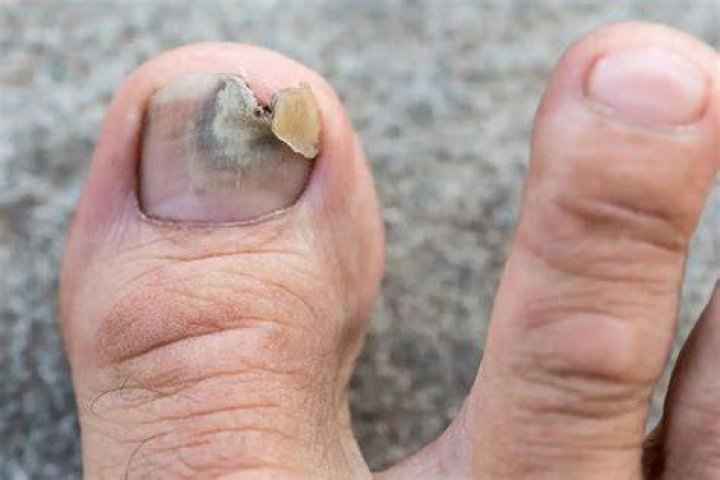 Will toenail fungus ever go away?